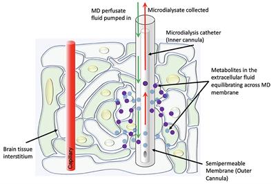 Cerebral microdialysis and glucopenia in traumatic brain injury: A review